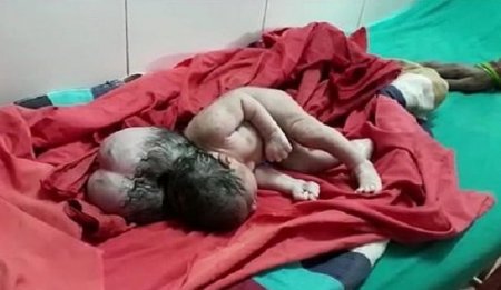 Hindistanda üçbaşlı uşaq dünyaya gəldi - FOTO