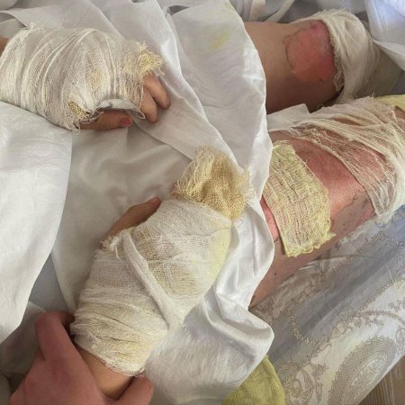 400 minlik toyu olan Aysel bardakı partlayışdan sonra tanınmaz hala düşdü – FOTO