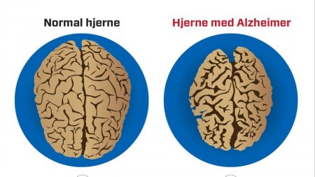ALTSHEYMER XƏSTƏLİYİ - DR ALİYEVA TELLİ