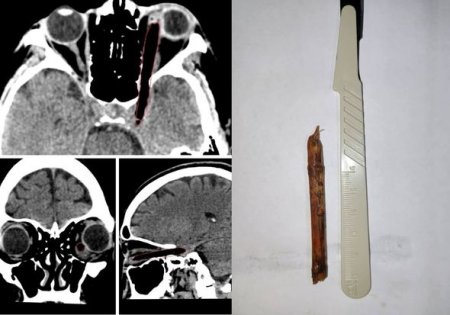 Rusiyada həkimlər qadının gözündən səkkiz santimetrlik budaq parçası çıxarıblar - FOTO