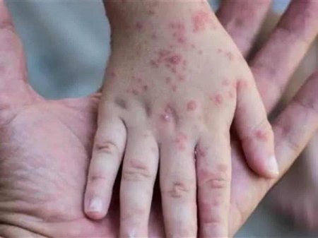 Meymunçiçəyi virusu (Monkeypox) ilə bağlı ilk yoluxma faktı ölkəmizdə qeydə alınıb. - FOTO Meymunçiçəyi virusu (Monkeypox) ilə bağlı ilk yoluxma faktı ölkəmizdə qeydə alınıb. - FOTO