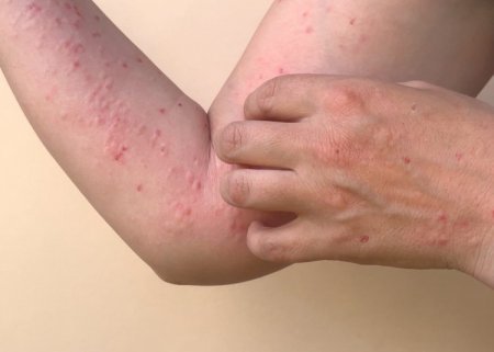 Meymunçiçəyi virusu (Monkeypox) ilə bağlı ilk yoluxma faktı ölkəmizdə qeydə alınıb. - FOTO Meymunçiçəyi virusu (Monkeypox) ilə bağlı ilk yoluxma faktı ölkəmizdə qeydə alınıb. - FOTO