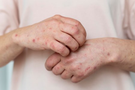 Meymunçiçəyi virusu (Monkeypox) ilə bağlı ilk yoluxma faktı ölkəmizdə qeydə alınıb. - FOTO Meymunçiçəyi virusu (Monkeypox) ilə bağlı ilk yoluxma faktı ölkəmizdə qeydə alınıb. - FOTO